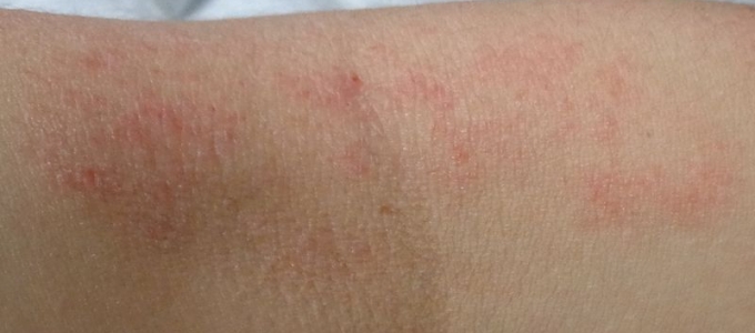Consejos para tratar la dermatitis atópica